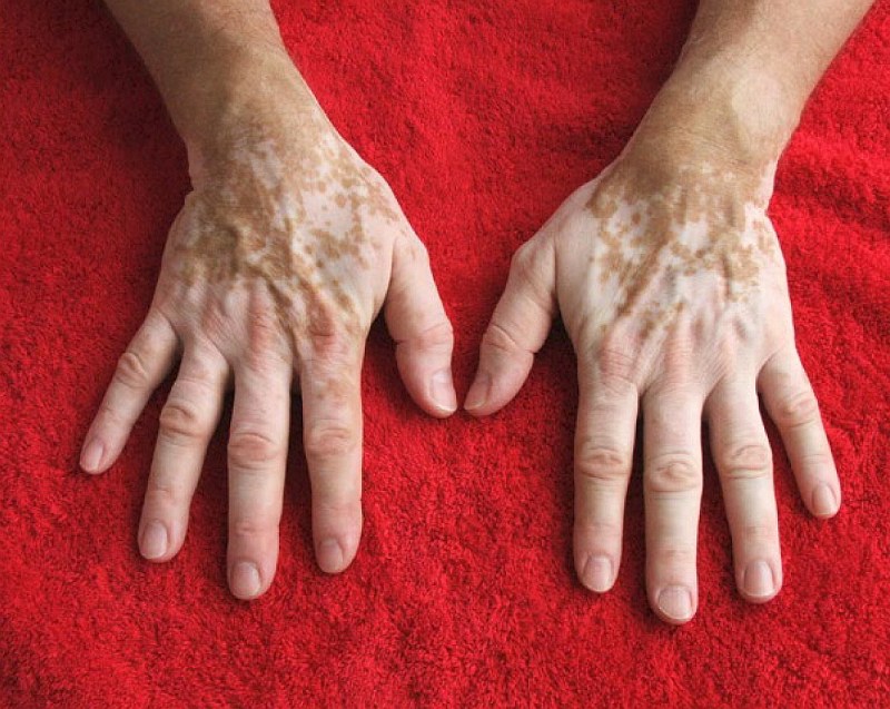 Aufnahme von zwei Händen mit der Pigmentstörung Vitiligo