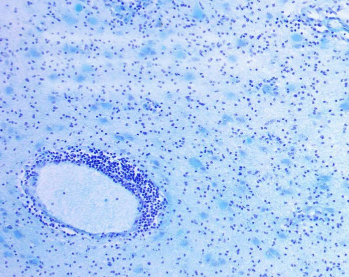 Das Bild zeigt Demyelinisierung bei Multipler Sklerose unter dem Mikroskop