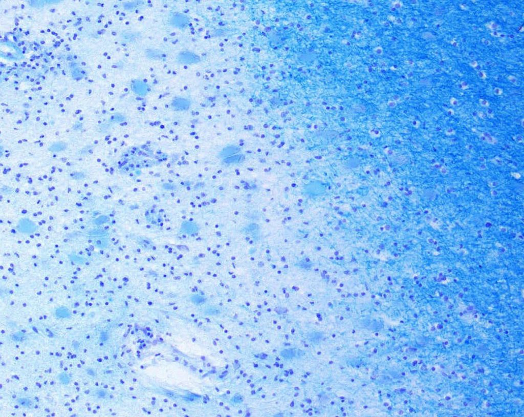 Das Bild zeigt Demyelinisierung bei Multipler Sklerose unter dem Mikroskop