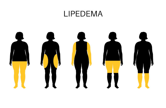 Grafische Darstellung der Fettverteilung bei Lipödem-Patientinnen