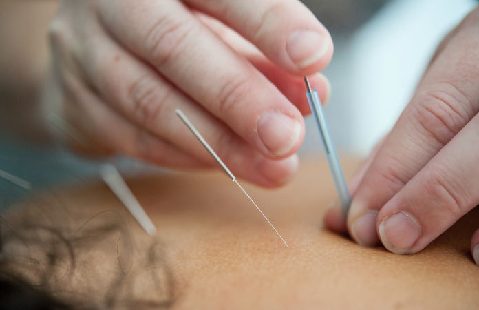 Auf dem Rücken eines Menschens werden Akupunkturnadeln platziert.